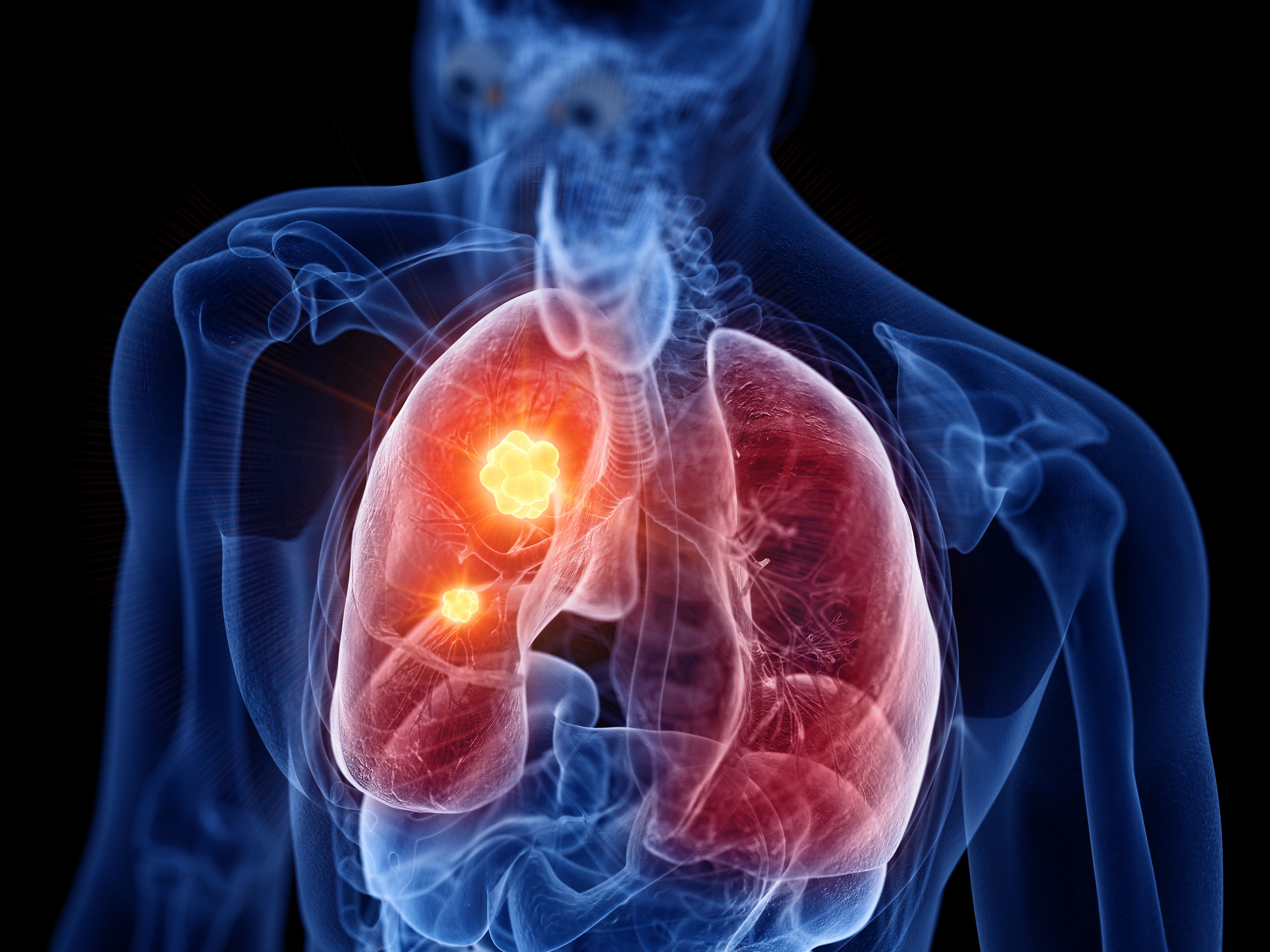 3D rendered image of human lungs with tumor