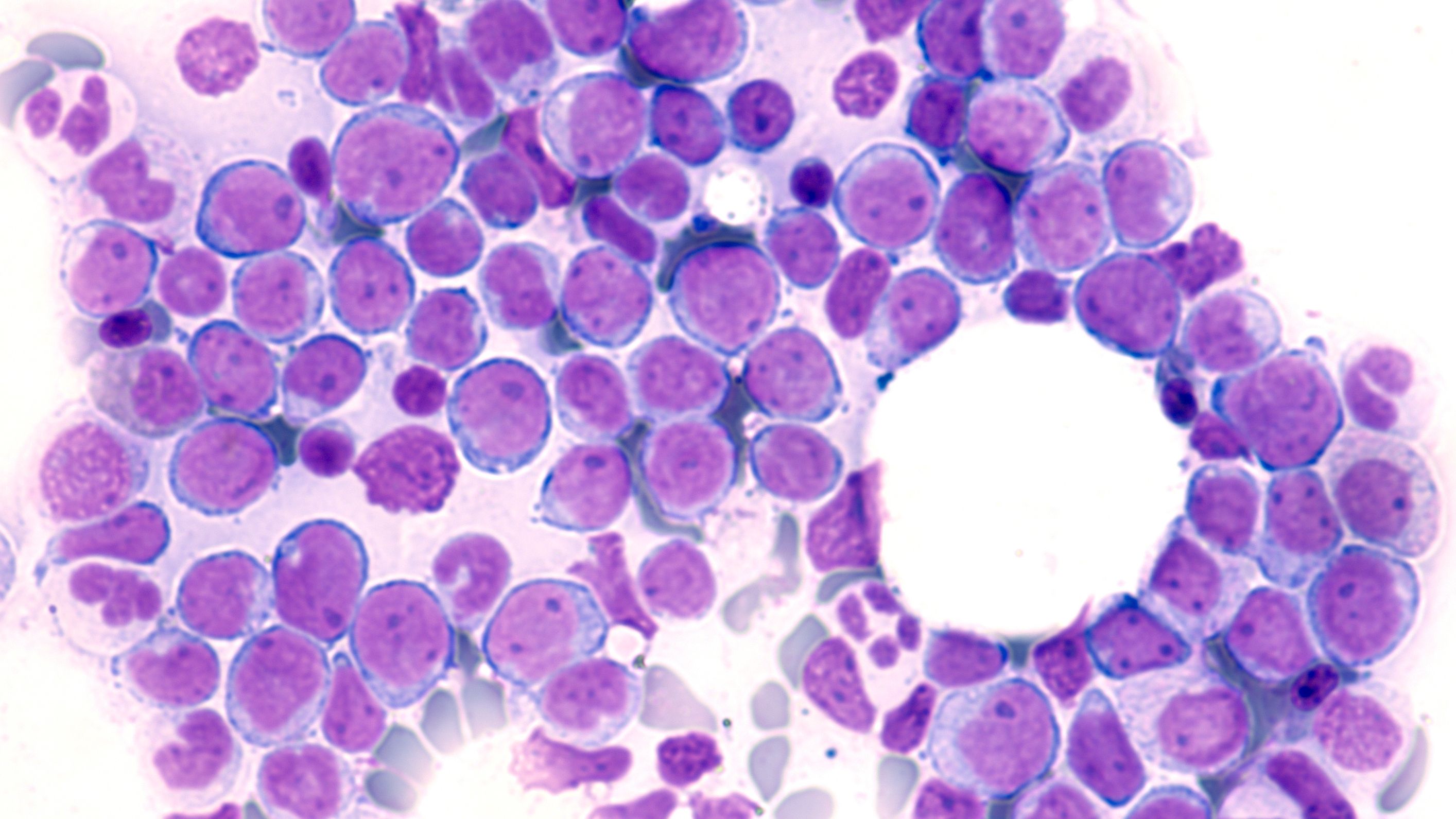 Acute myeloid leukemia -- Image credit: David A Litman | stock.adobe.com