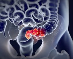 Mirati Releases Promising Adagrasib Results for Advanced Colorectal Cancer