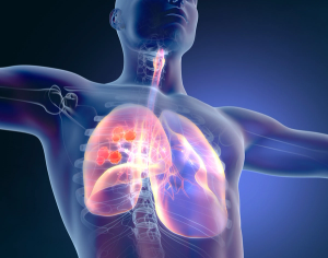 Genentech: Phase 3 Study of Immunotherapy in ES-SCLC Fails to Meet Co-primary Endpoint