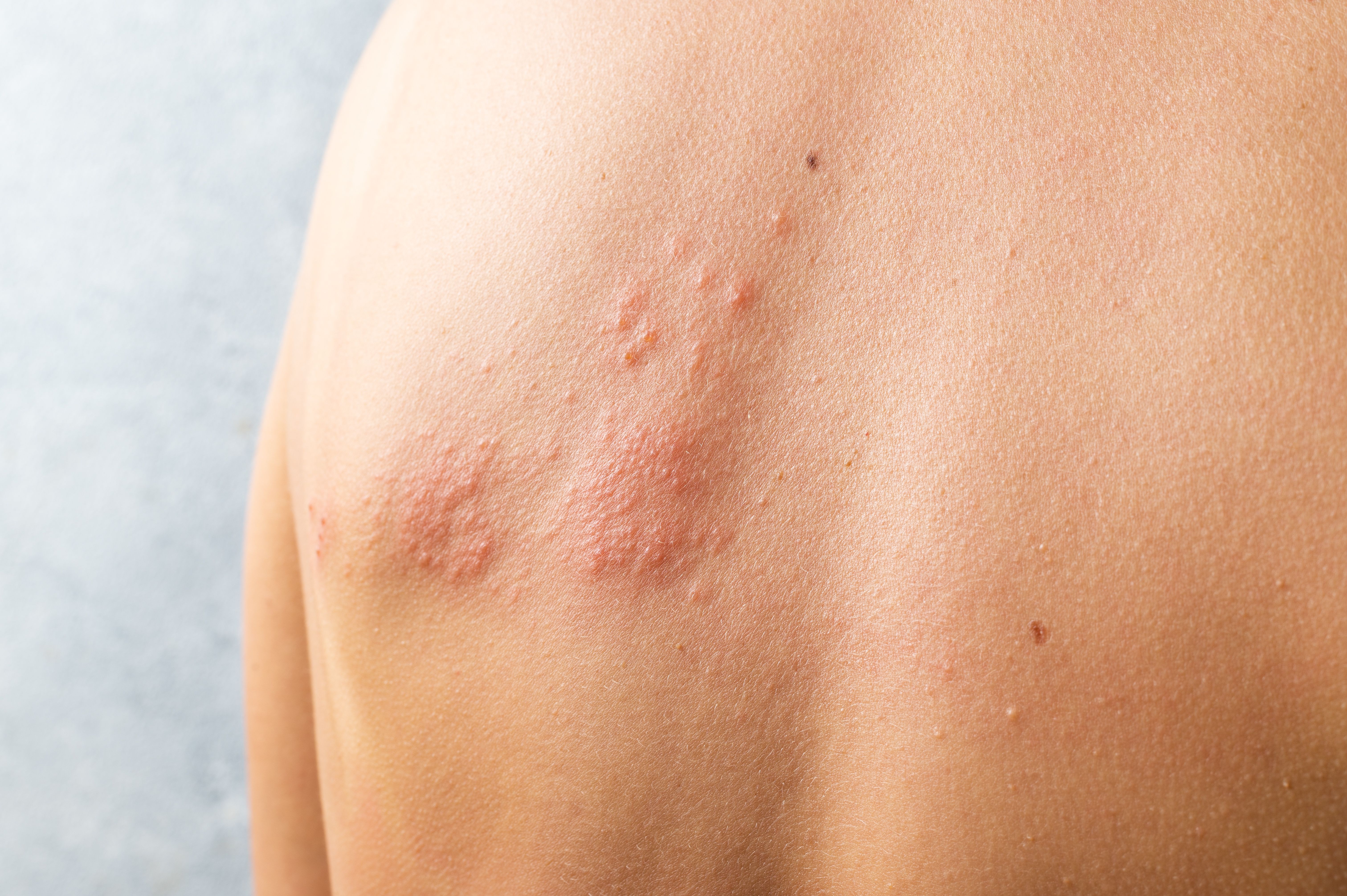 Skin infected Herpes zoster virus. Herpes Virus on body. urticaria rash. atopic dermatitis on body - Image credit: sashka1313 | stock.adobe.com
