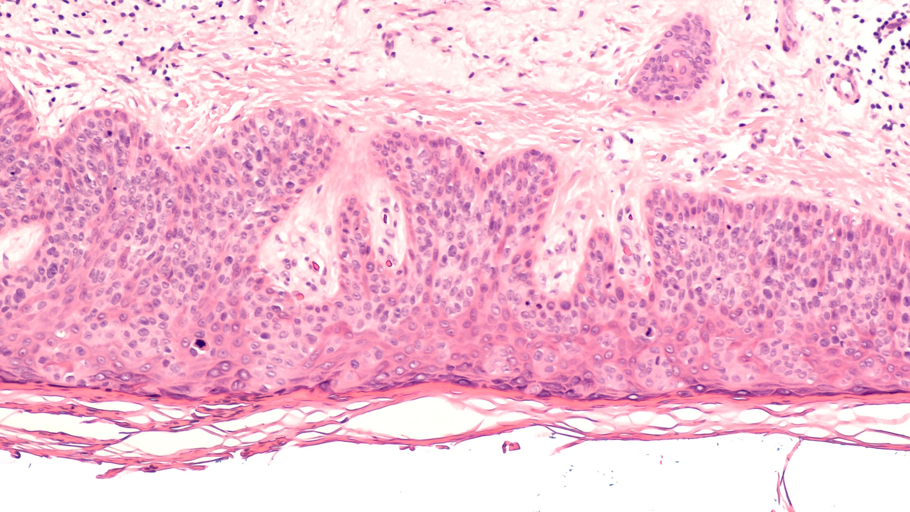 Microscopic view of skin cancer