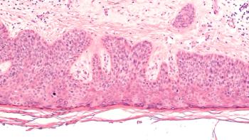 Microscopic view of skin cancer