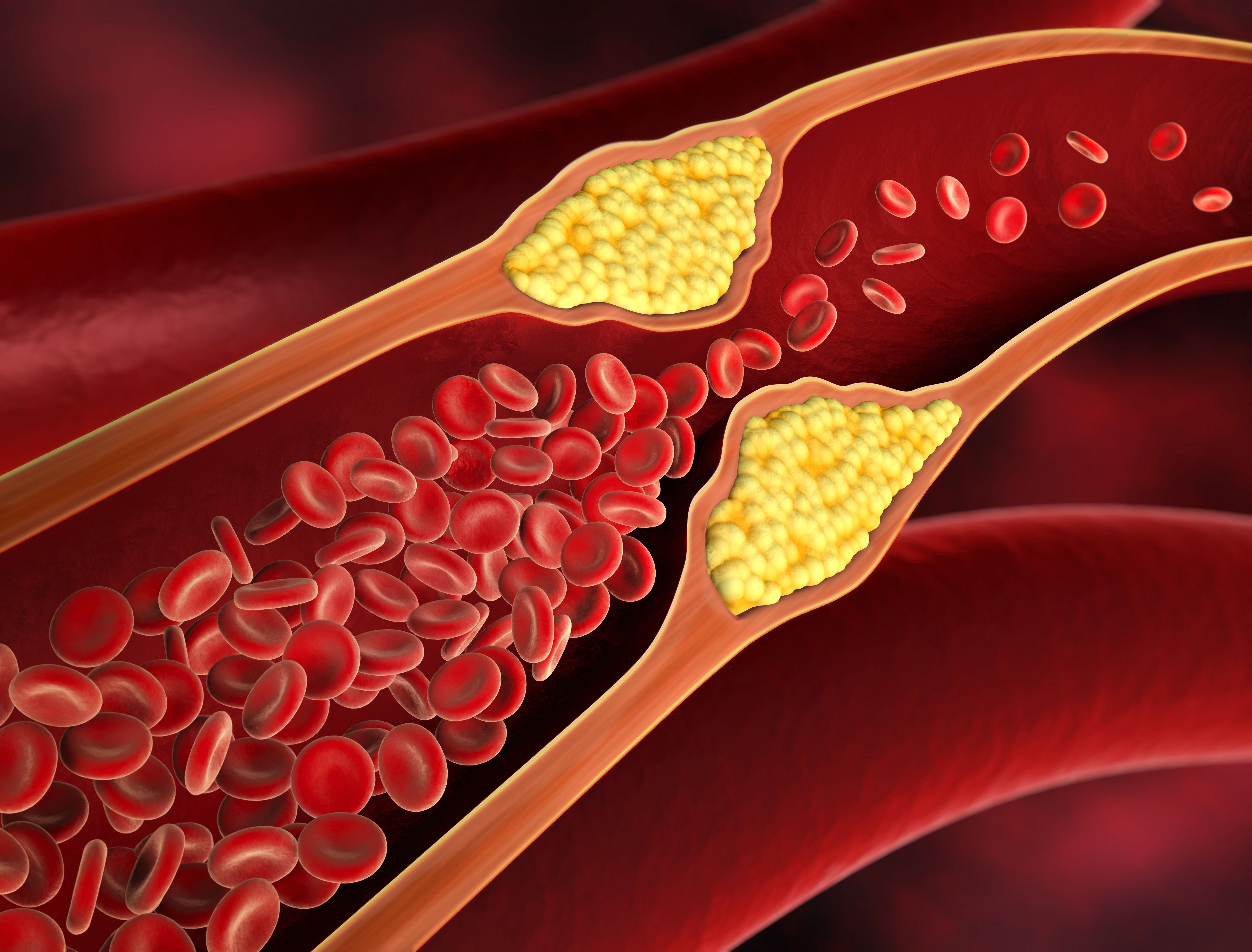Stroke is also known to be driven by hypertension, diabetes, and dyslipidemia. | Image Credit: peterschreiber.media | stock.adobe.com