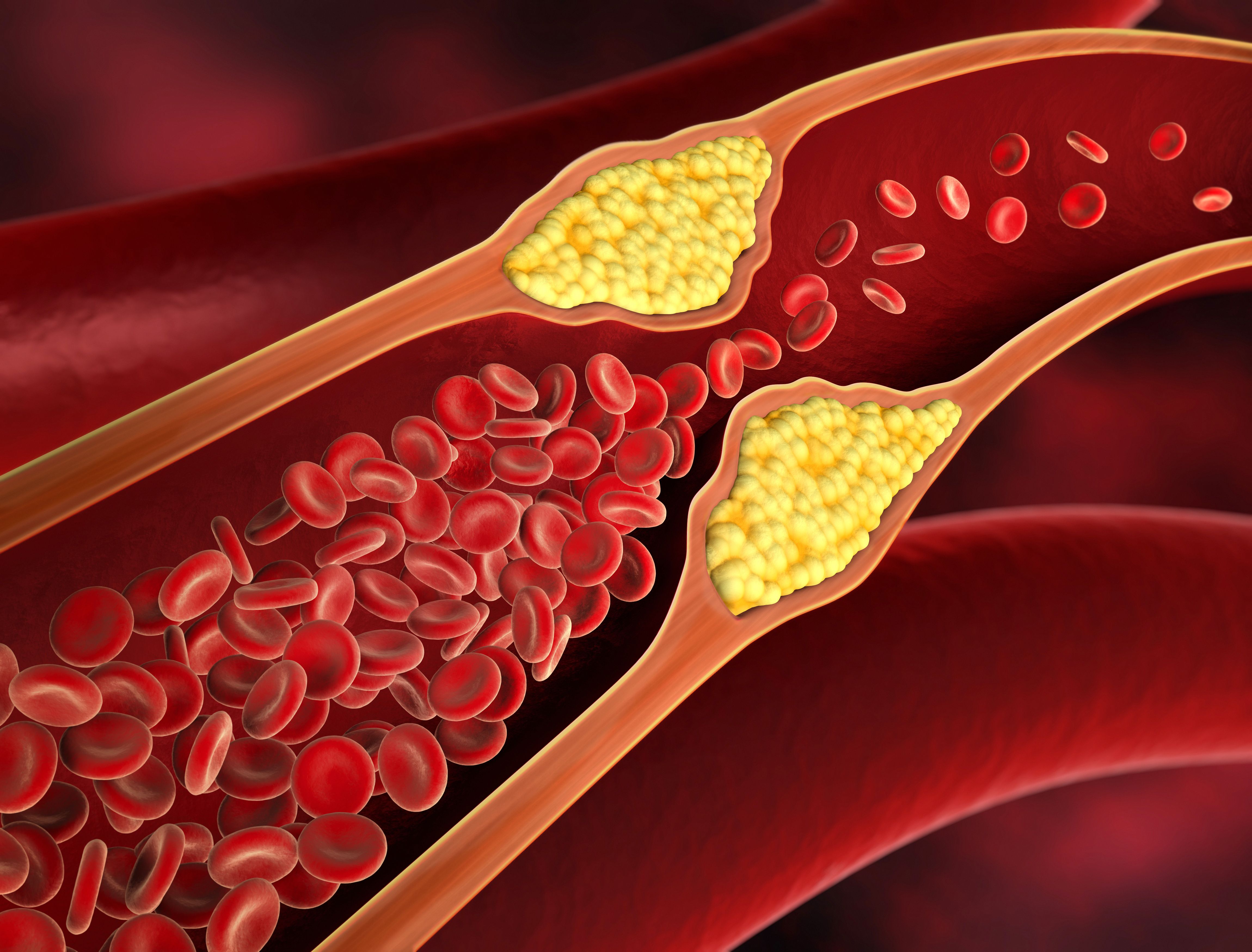 High cholesterol -- Image credit: peterschreiber.media | stock.adobe.com