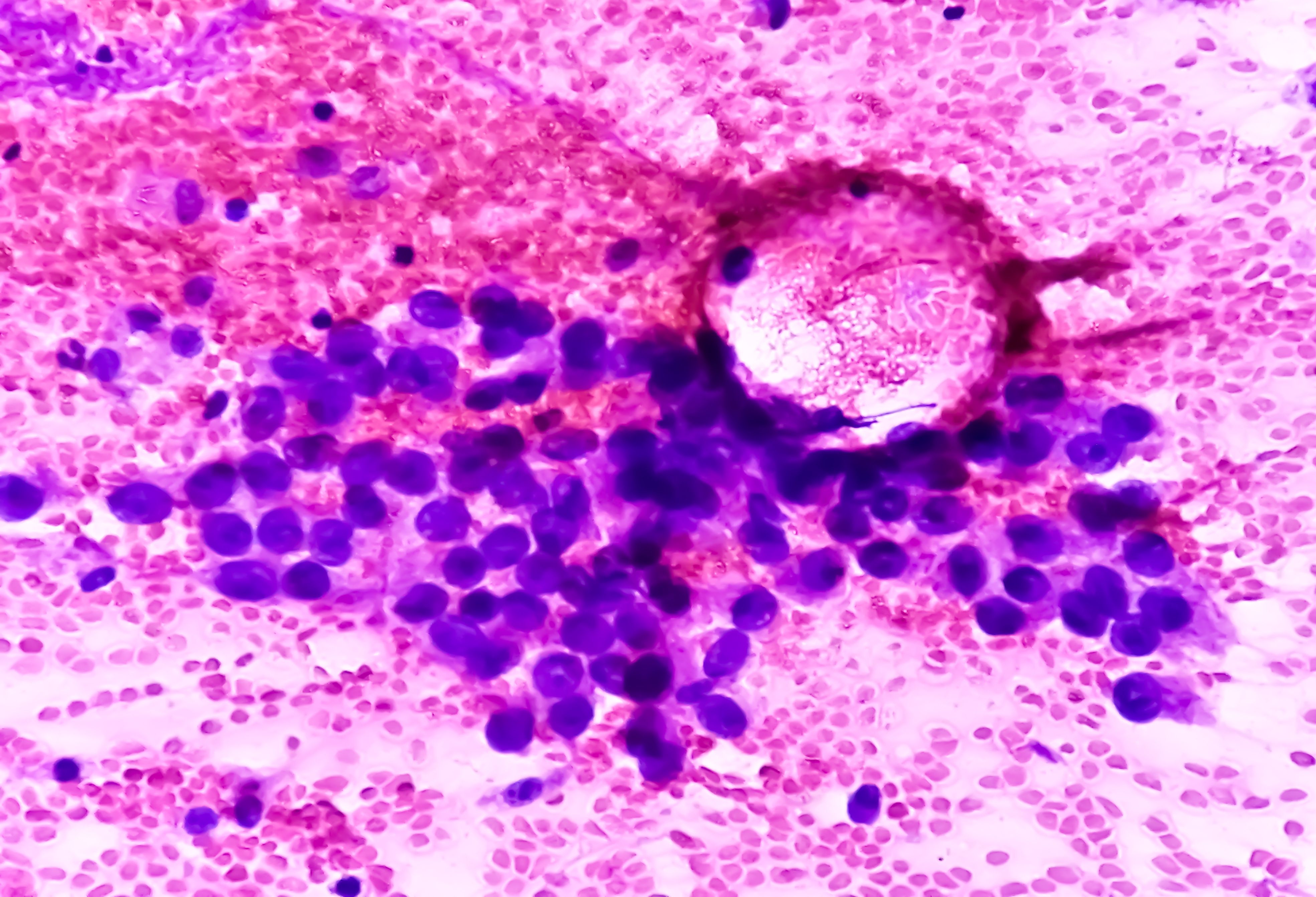 Photomicrograph of fine needle aspiration (FNA) cytology of a pulmonary (lung) nodule showing adenocarcinoma, a type of non small cell carcinoma - Image credit: Saiful52 | stock.adobe.com