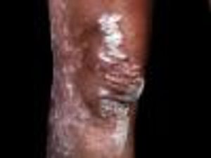 Phase 3 Trial for Psoriasis Vulgaris Drug Enrolls First Patient
