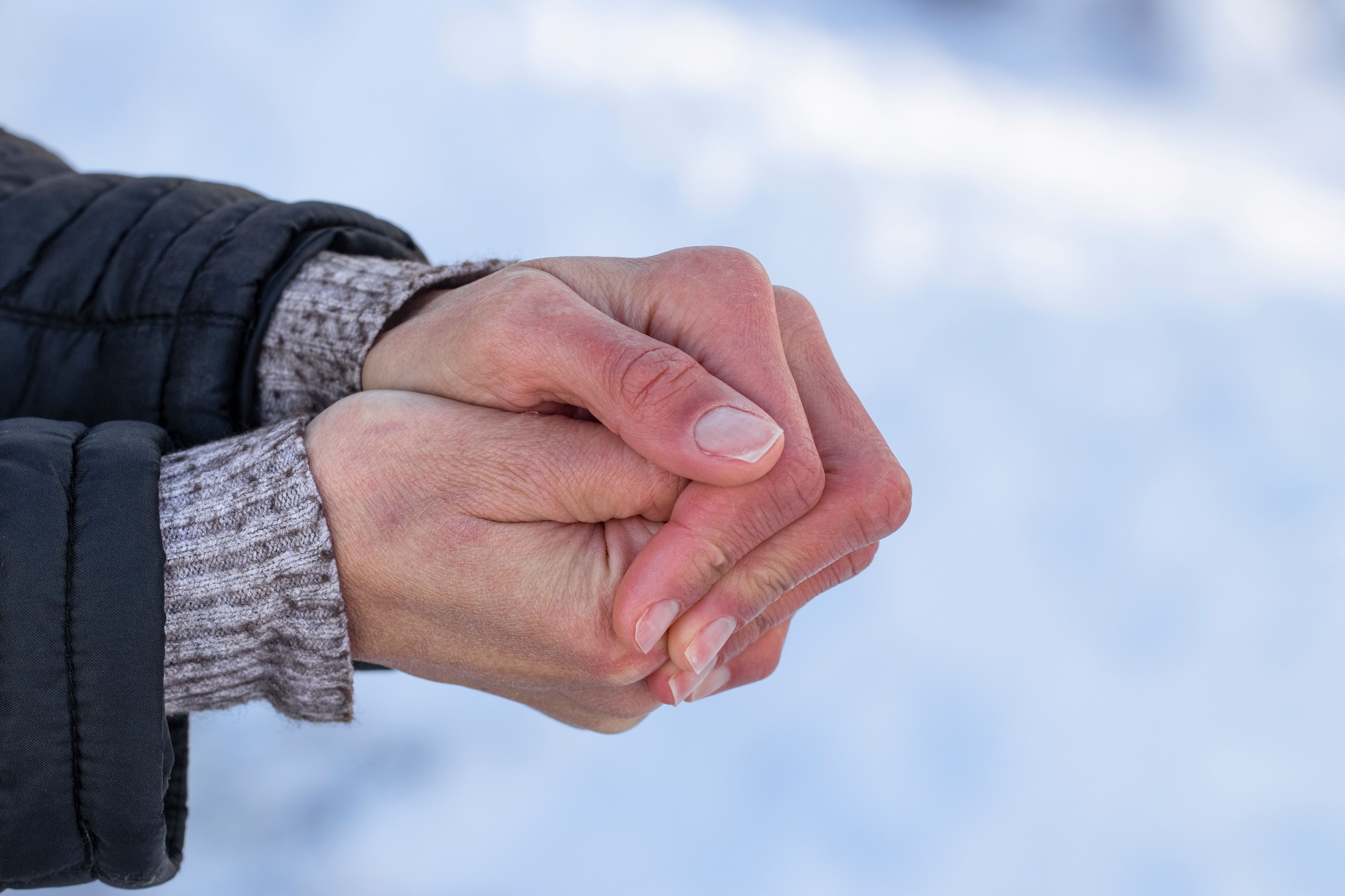 FDA Approves Iloprost Injection For the Treatment of Adults With Severe Frostbite