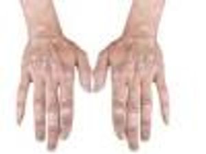 Quick Self-Assessment Effective for Psoriatic Arthritis