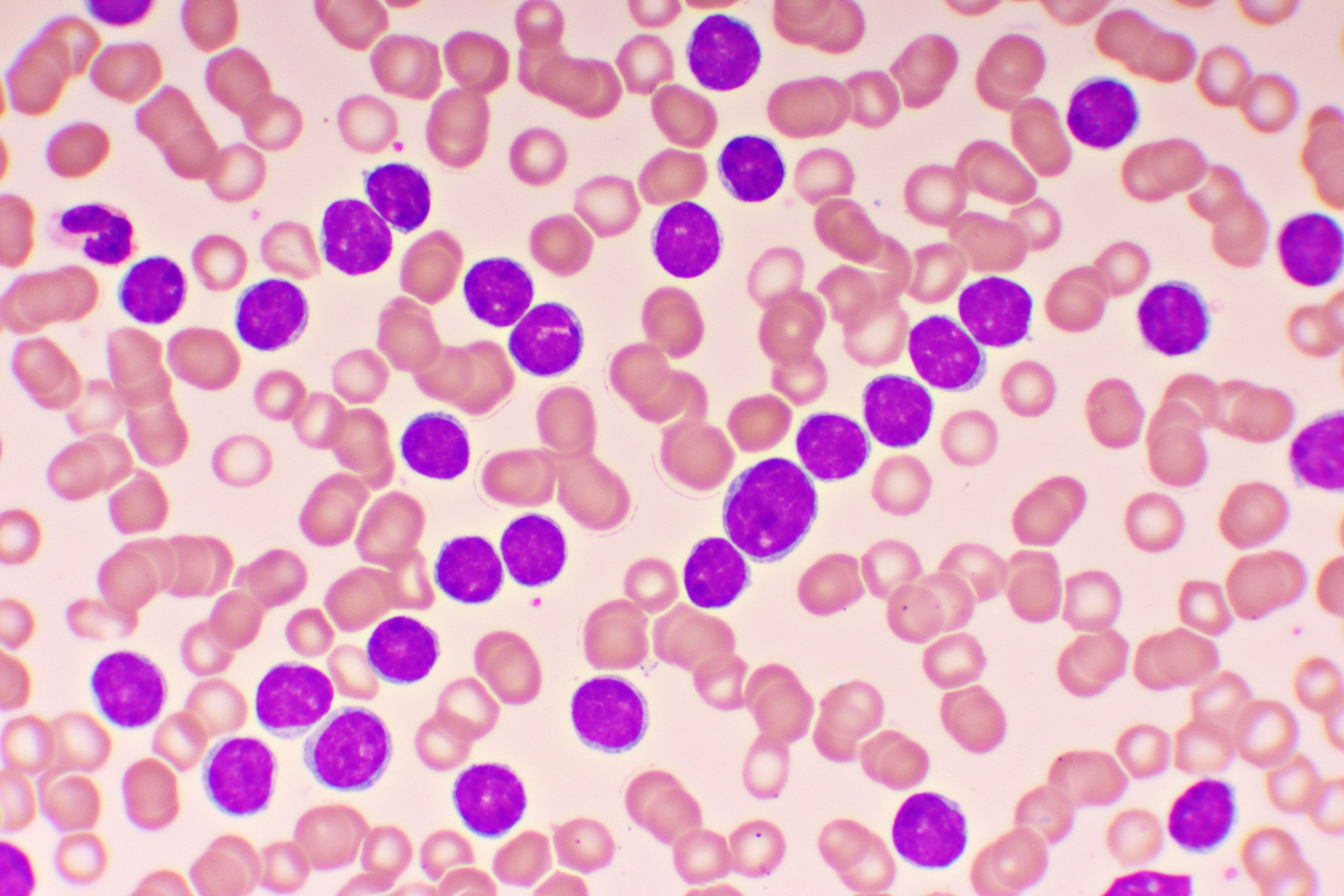 Chronic lymphocytic leukemia -- Image credit: jarun011 | stock.adobe.com