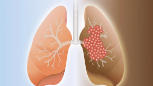 Stock.adobe.com small cell lung cancer