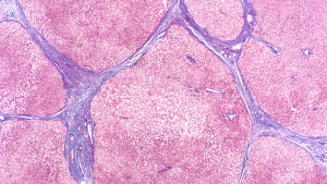stock.adobe.com fibrosis