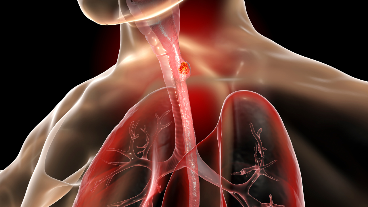 FDA Approves Tevimbra, BeiGene’s Treatment for Adults with Unresectable or Metastatic Esophageal Squamous Carcinoma