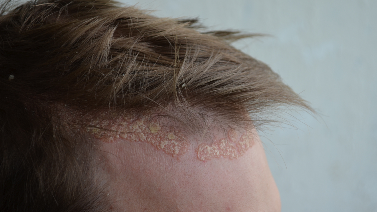 Tremfya Rash Johnson & Johnson’s Tremfya Displays Considerable Clearance of Scalp ...