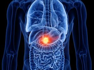 The FDA approved daraxonrasib (Rasonque), the first RAS-directed therapy for previously treated metastatic pancreatic adenocarcinoma, after a phase 3 trial showed median overall survival of 13.2 months versus 6.7 months with chemotherapy. Credit: Stock.Adobe.com/Sebastian Kaulitzki