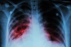 Janssen Sends Data for Phase III Children’s Pulmonary Tuberculosis Treatment to FDA and EMA