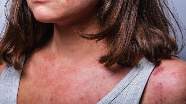 a young girl with atopic dermatitis in the acute stage. redness and scratching up to blood on the body close-up. Dermatology | Image credit: © Ksenia Kirillovykh - © Ksenia Kirillovykh - stock.adobe.com