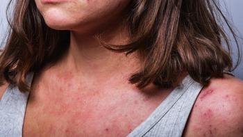 a young girl with atopic dermatitis in the acute stage. redness and scratching up to blood on the body close-up. Dermatology | Image credit: © Ksenia Kirillovykh - © Ksenia Kirillovykh - stock.adobe.com