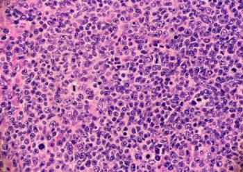 Image Credit: Adobe Stock Images/Lisa. High grade follicular lymphoma with marginal zone differentiation.