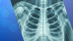 GSK Acquires Nuvalent for $10.6 Billion in Lung Cancer Push