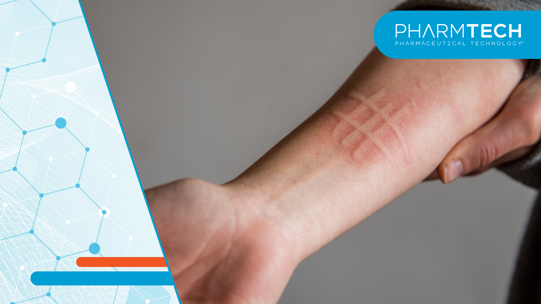 Remibrutinib, an oral BTK inhibitor, is FDA approved as the first symptomatic dermographism therapy.