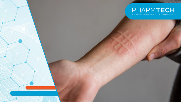 Remibrutinib, an oral BTK inhibitor, is FDA approved as the first symptomatic dermographism therapy.