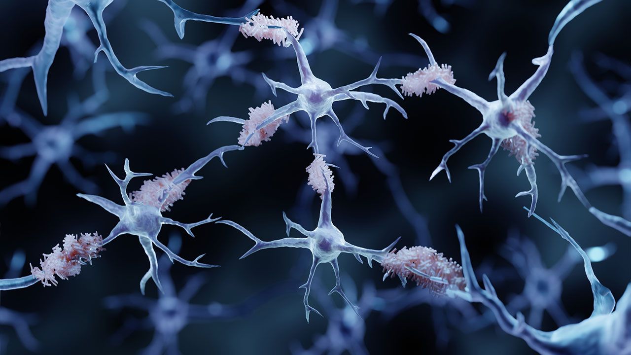 <![CDATA[European Biotechs Impacting Treatment of Alzheimer’s Disease]]>