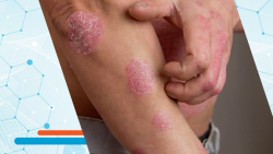 FDA Approves First Oral Peptide for Plaque Psoriasis