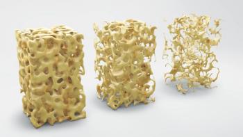 Bone structure 3d illustration, normal and with osteoporosis | Image Credit: © adimas - stock.adobe.com