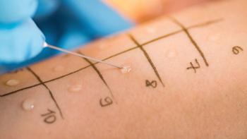 Skin Prick Allergy Testing |Image Credit: © Microgen - © Microgen - stock.adobe.com