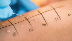 Skin Prick Allergy Testing |Image Credit: © Microgen - © Microgen - stock.adobe.com
