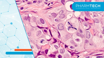 Photomicrograph of a breast cancer (grade 3 invasive ductal carcinoma) with frequent mitoses (mitotic figures), including a large central atypical mitosis. | Image Credit: ©David A Litman -stock.adobe.com