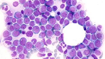 Leukemia Awareness: Photomicrograph of bone marrow aspirate showing myeloblasts of acute myeloid leukemia (AML), a cancer of white blood cells. | Image Credit: ©David A Litman -stock.adobe.com