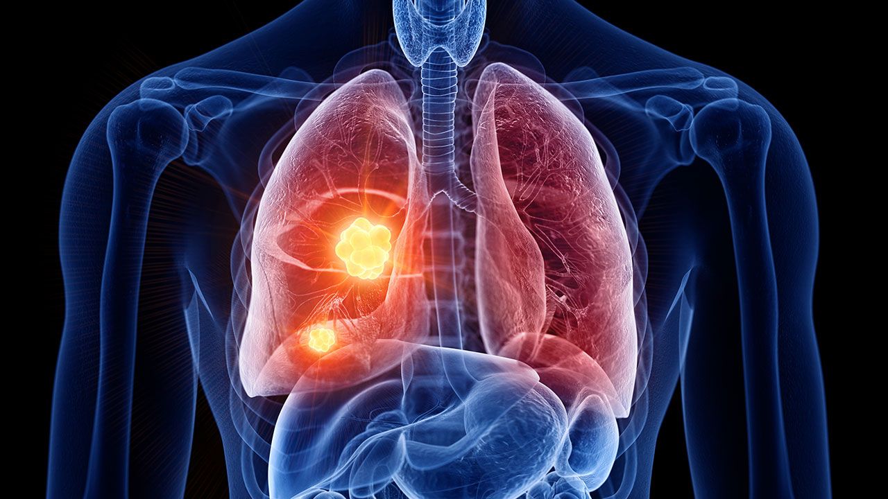 3d rendered medically accurate illustration of lung cancer | Image Credit: ©Sebastian Kaulitzki -stock.adobe.com