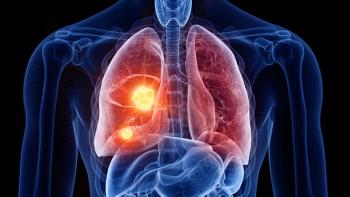 3d rendered medically accurate illustration of lung cancer | Image Credit: ©Sebastian Kaulitzki -stock.adobe.com