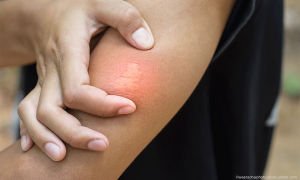 Stinging insect allergy tests evolve to improve diagnosis precision