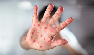 measles, patient communication, vaccine, MMR, antivaxxer, physician
