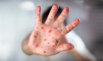 measles, patient communication, vaccine, MMR, antivaxxer, physician