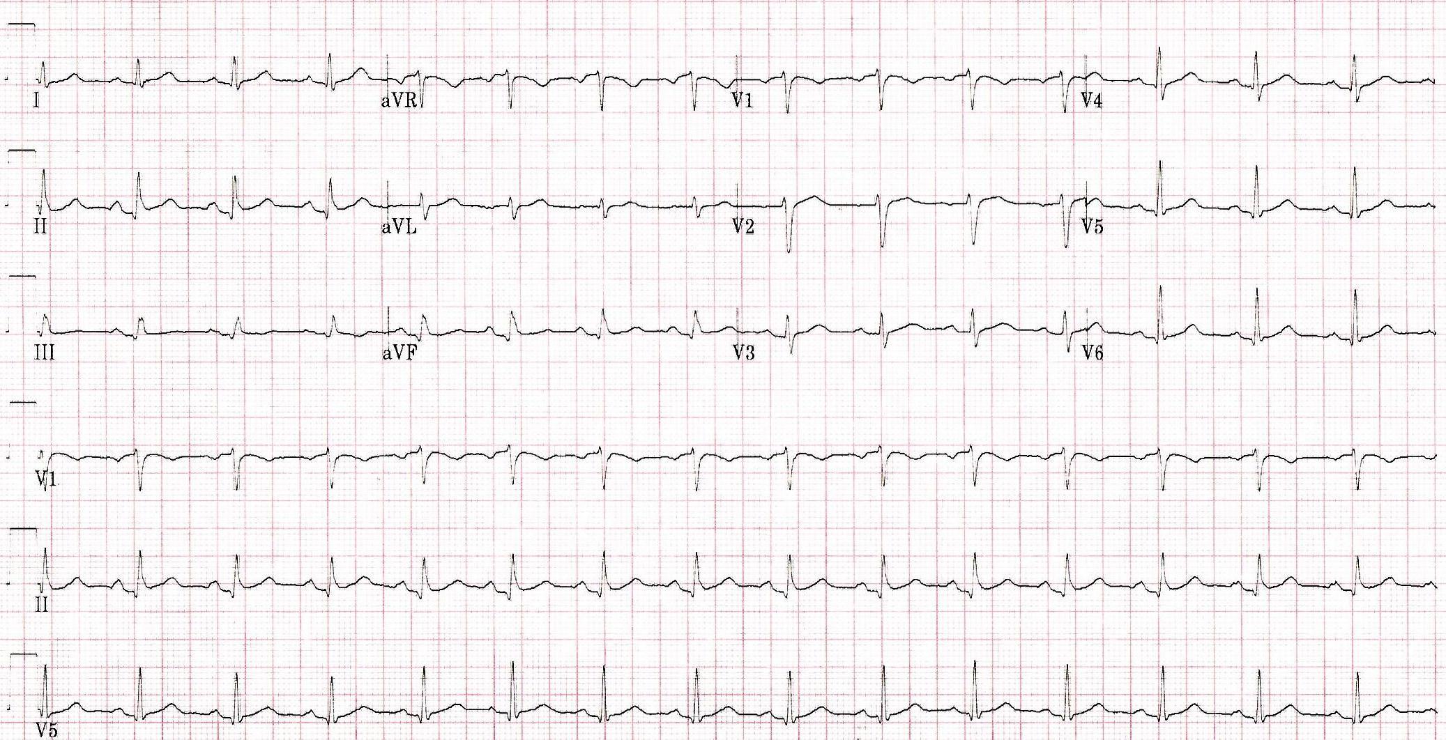 Cardiology Case Report Pleurisy