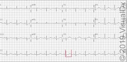 Image IQ:  Syncope, Seizure and Hypokalemia ...Can You Diagnose This Patient? 