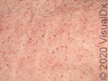 Image IQ: 13-Year-Old Complains of Abdominal Pain, Red Dots, and