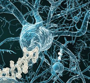 Managing Psychosis in Patients With Alzheimer Disease