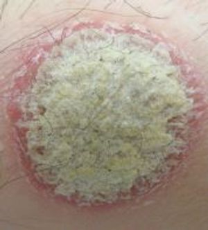 Treating Psychiatric Patients With Psoriasis: Clinical Considerations
