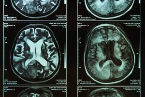 transcranial magnetic stimulation at-home depression treatment
