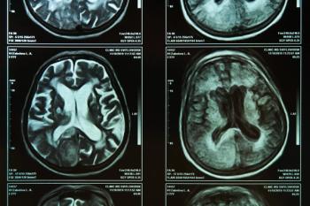 transcranial magnetic stimulation at-home depression treatment