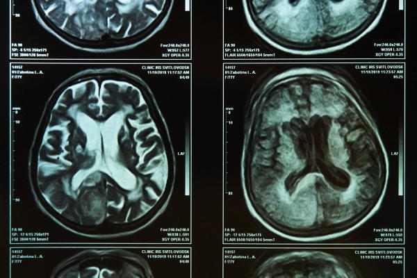 transcranial magnetic stimulation at-home depression treatment