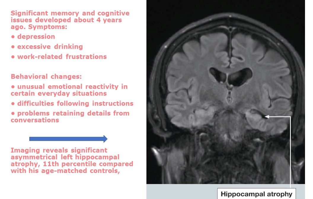 4 Stages Of Chronic Traumatic Encephalopathy