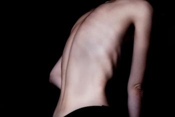 anorexia
