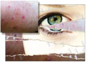 The Interface of Dermatology and Psychiatry