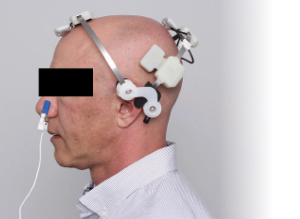 Will the Photobiomodulation Trial Be the One to Turn the Tide Against Alzheimer Disease?